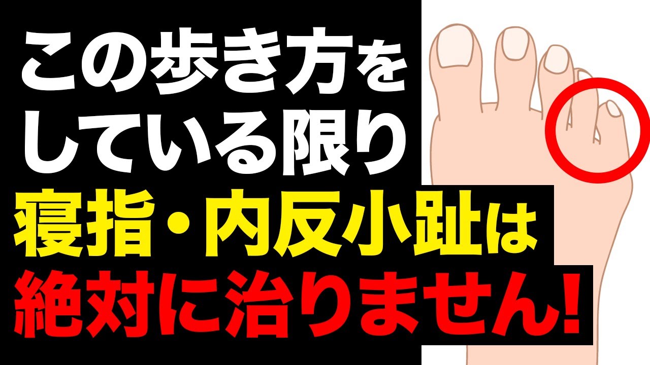 【注意⚠️】寝小指・内反小趾の人は膝が〇〇の歩き方をしている!?内反小趾を改善する歩き方｜鍼灸整体院リーフ｜足指ほぐし