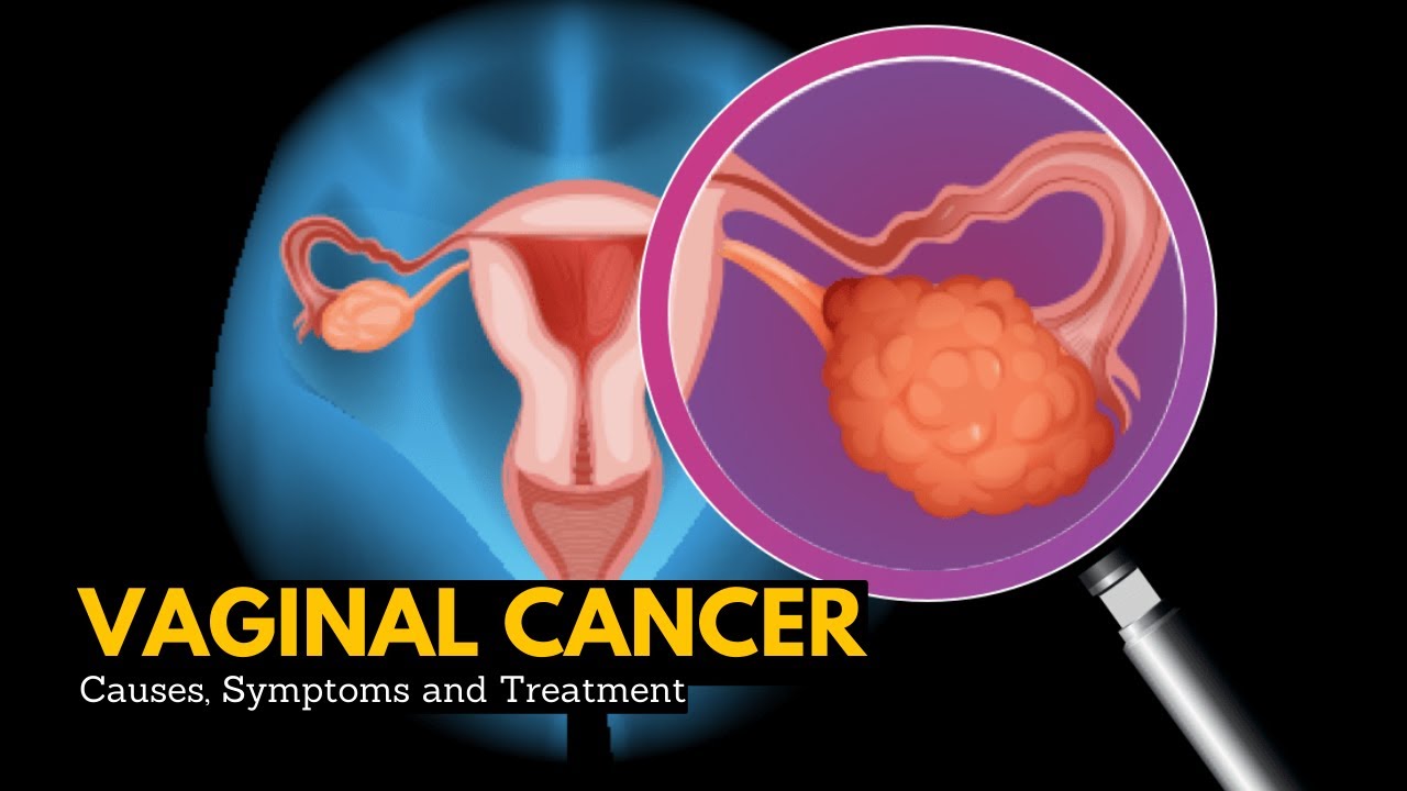 Vaginal cancer, Causes, Signs and Symptoms, DIagnosis and Treatment.