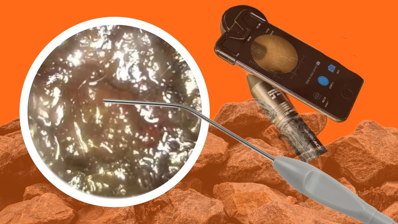 We tackle a ROCK HARD ear wax plug. #001