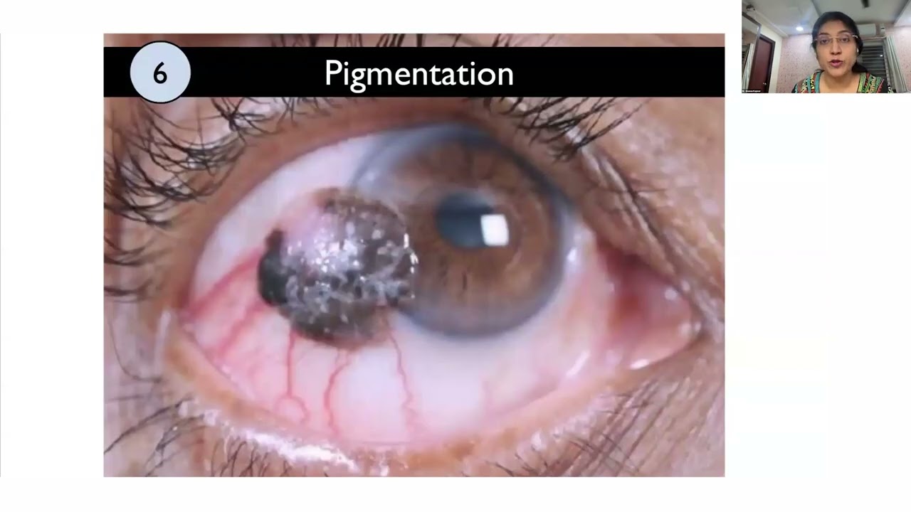 Lecture: A to Z of Ocular Surface Squamous Neoplasia