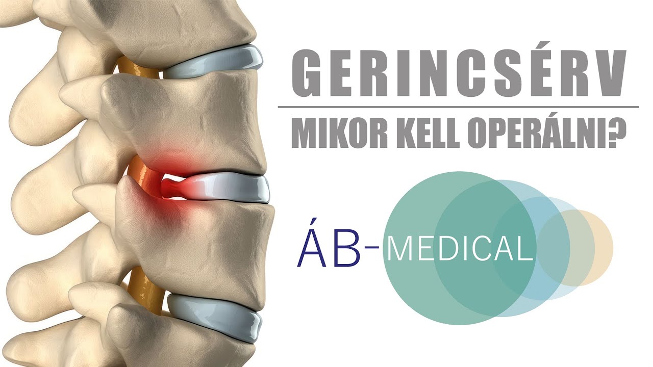 Gerincsérv - Mikor kell operálni? - Az Orvos Válaszol