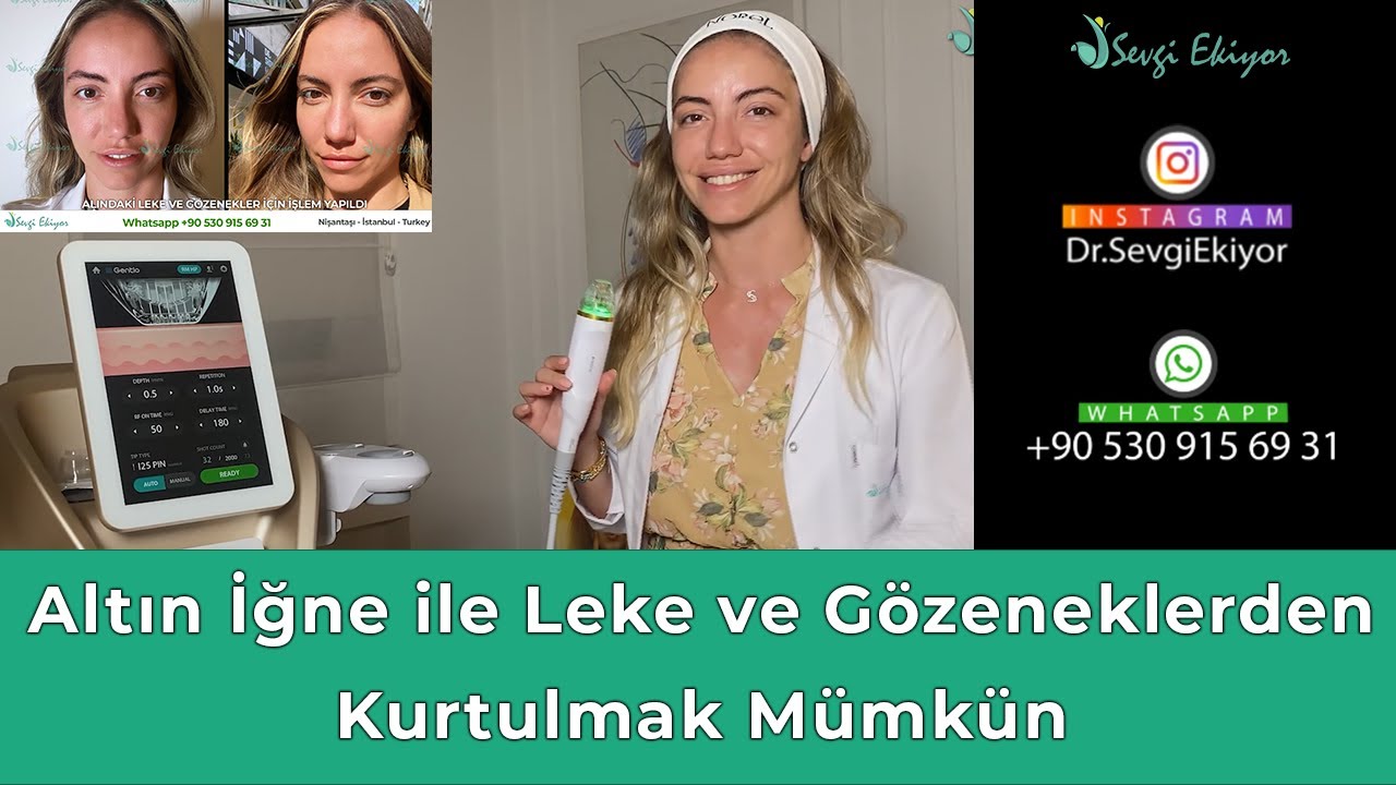 Altın İğne ile Leke ve Gözeneklerden Kurtulmak Mümkün