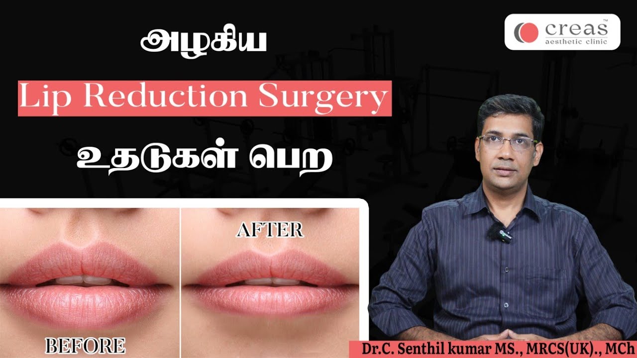 உதடுகளை அழகாக்கும் Lips Reduction Surgery | Easy Painless and 1hour Procedure - Dr.C Senthil Kumar