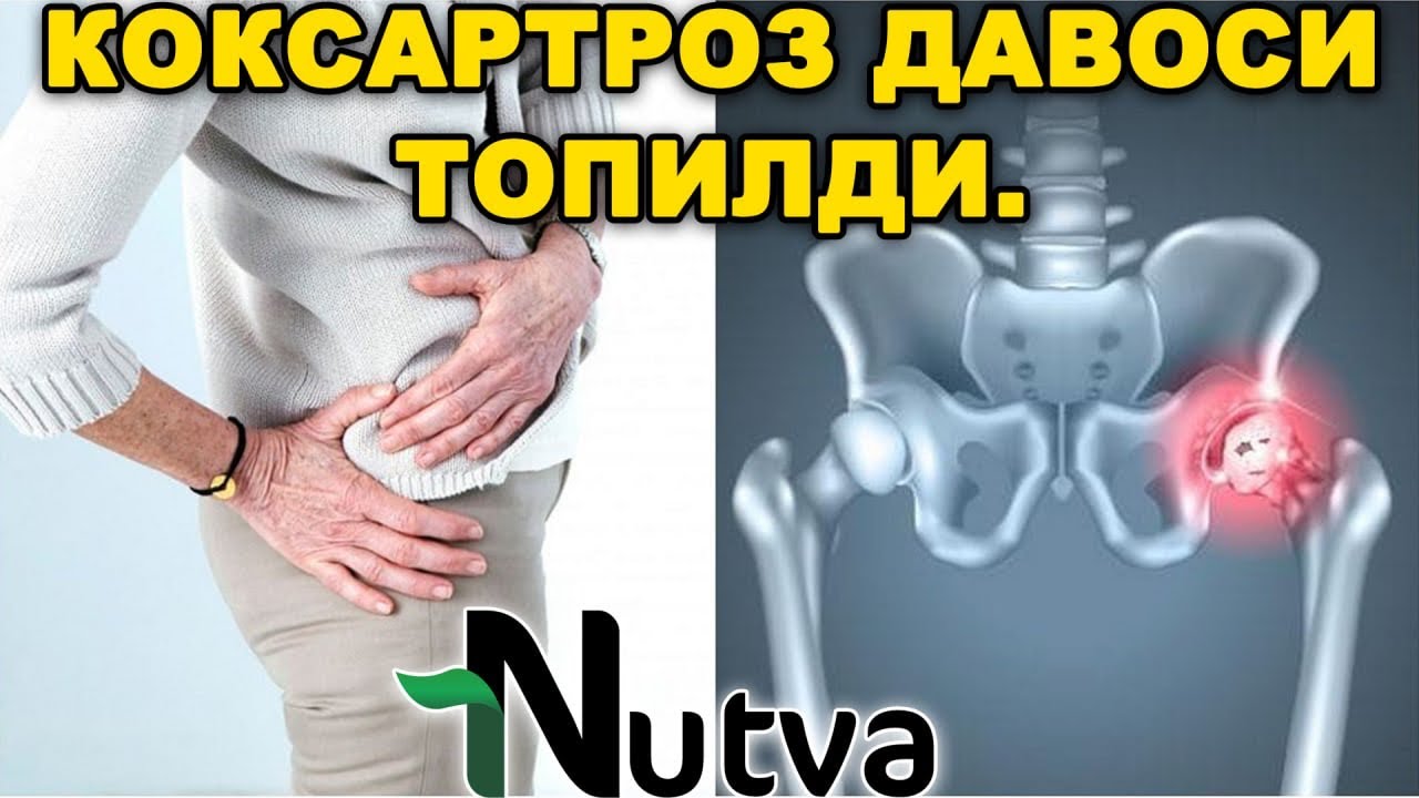КОКСАРТРОЗ ДАВОСИ ТОПИЛДИ