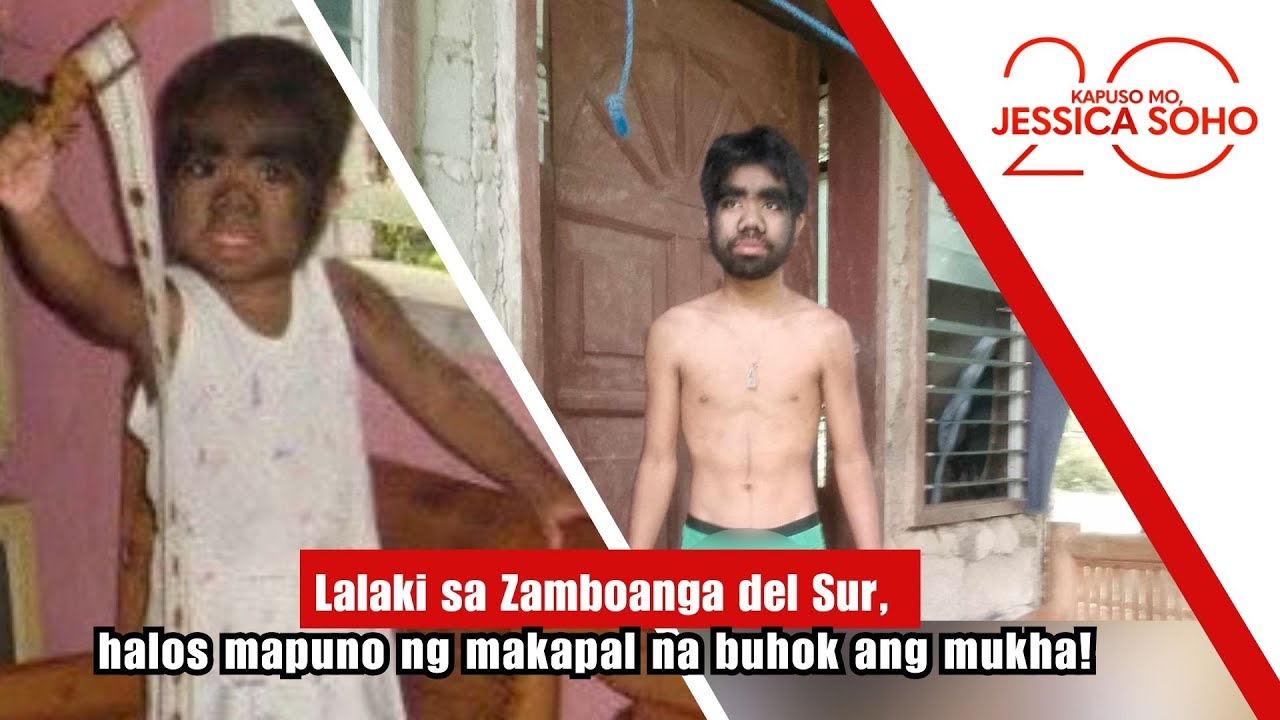 Lalaki sa Zamboanga del Sur, halos mapuno ng makapal na buhok ang mukha! | Kapuso Mo, Jessica Soho