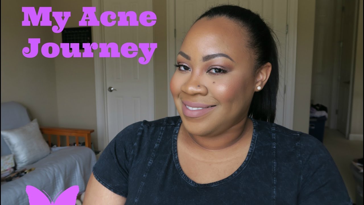 My Acne Journey⎮Hormonal Acne, PCOS, Treatment + Skincare Routine