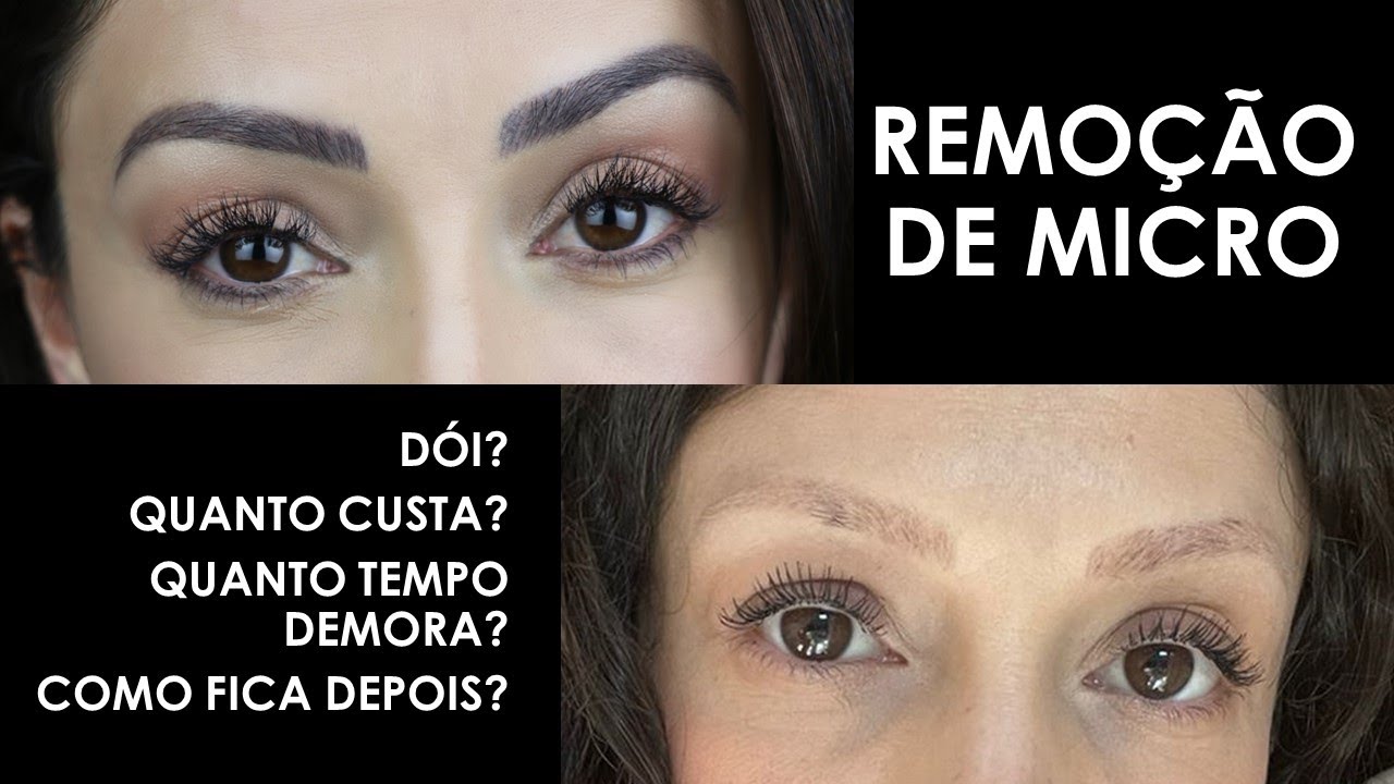 REMOÇÃO MICRO A LASER