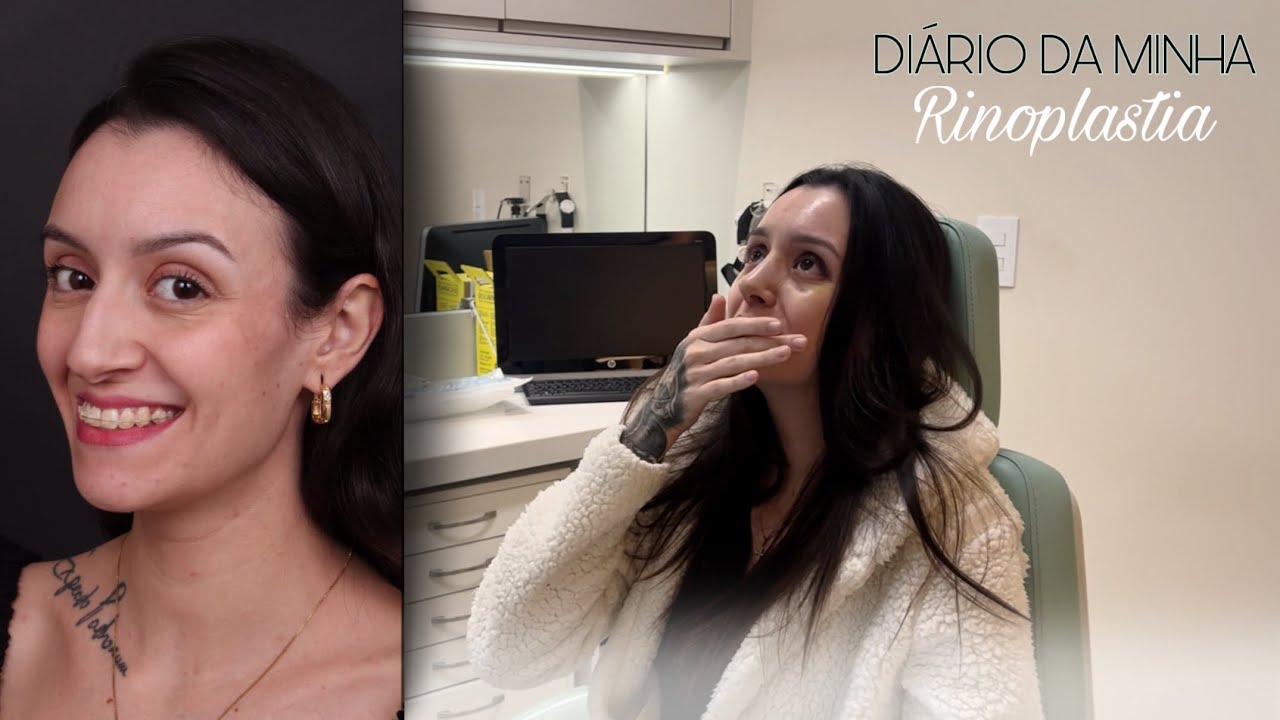 Minha rinoplastia - diário da rinoplastia + 14 dias pós.
