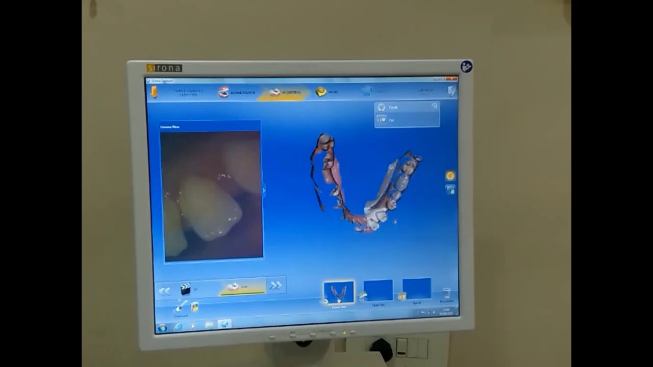 Cerec Omnicam IntraOral Scanning