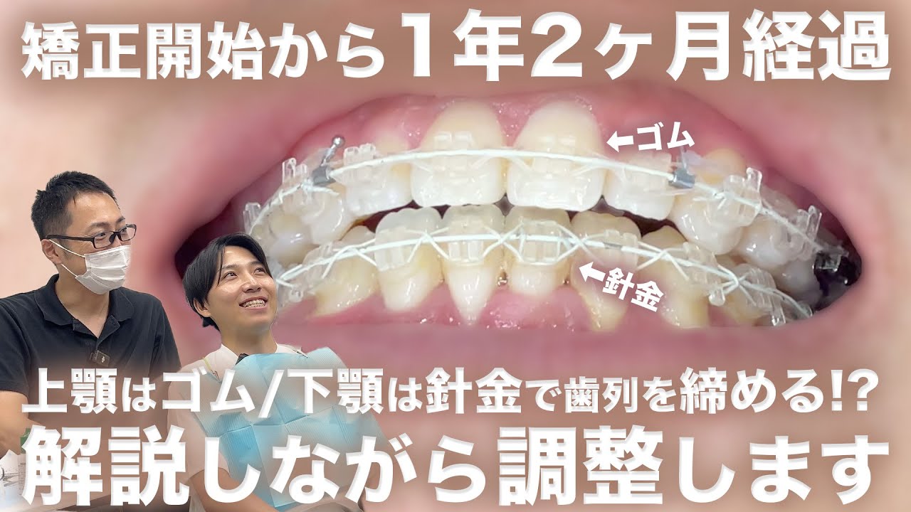 【矯正密着EP7】開咬で悩んでた患者様1年2ヶ月経過！調整の様子をほぼノーカットでお見せします【オープンバイト矯正】