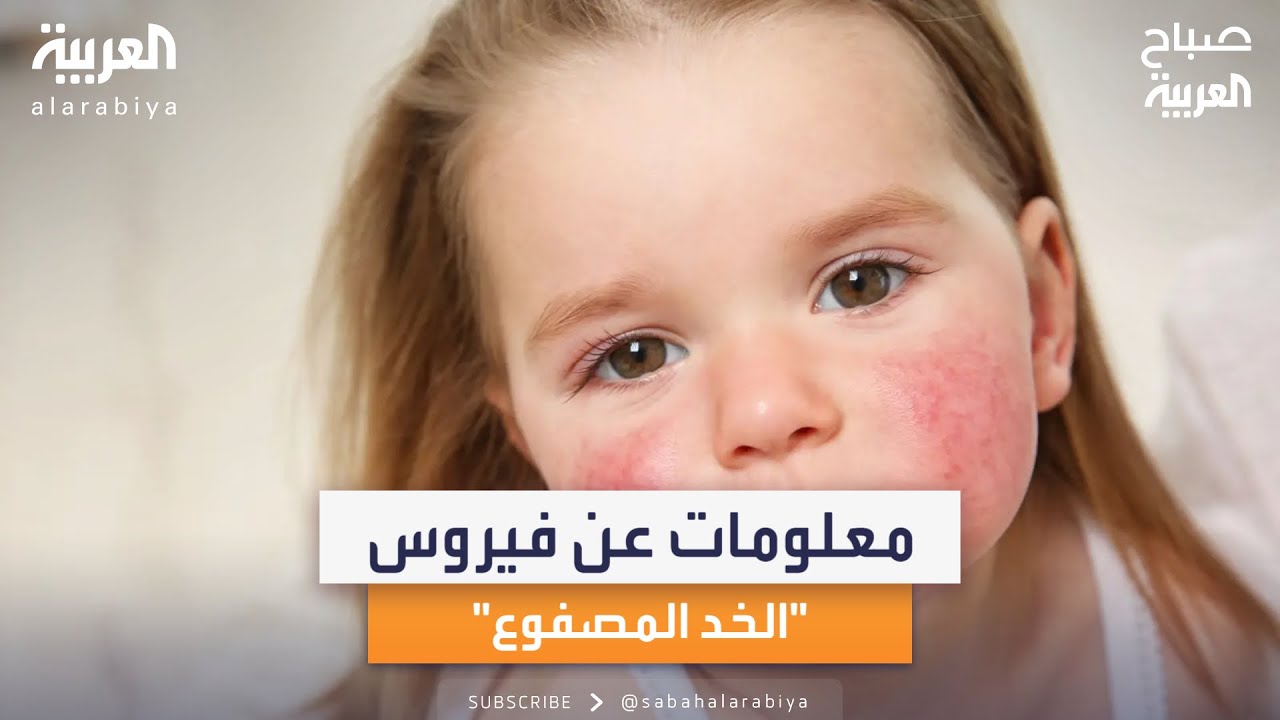بالأرقام.. معلومات عن فيروس الخد المصفوع قد لا تعرفها