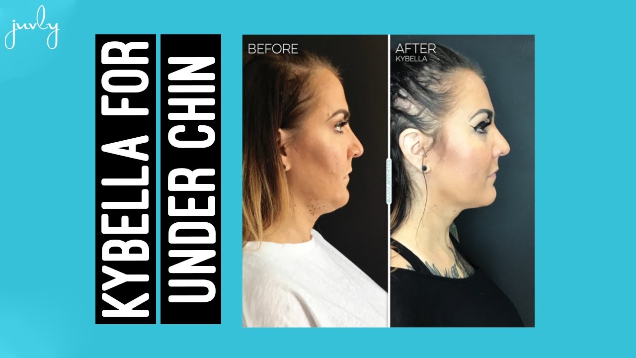 Learn More About Kybella Double Chin Fat Reduction Treatment With Master Provider Amber at Juvly