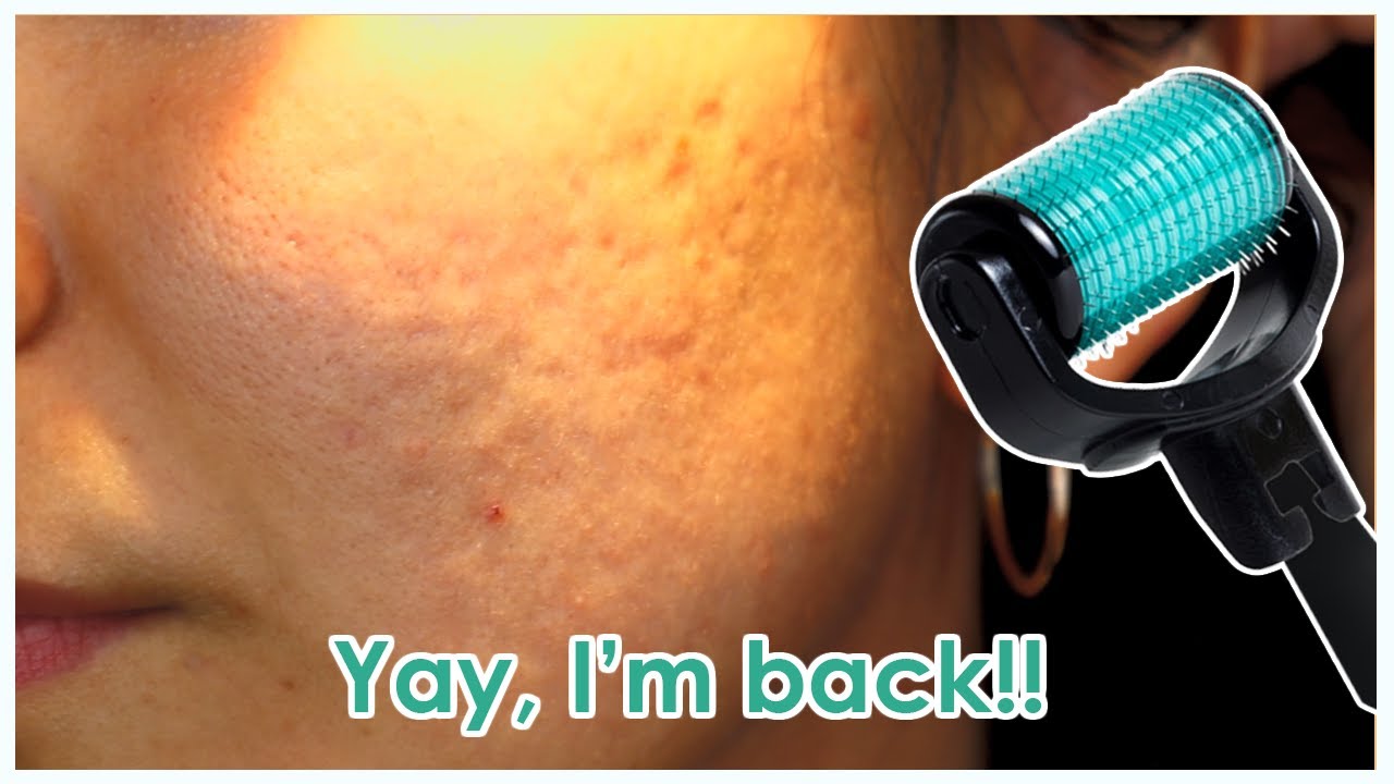 Acne scar dermaroling UPDATE! (Soo, I actually started using the 1.5mm..)