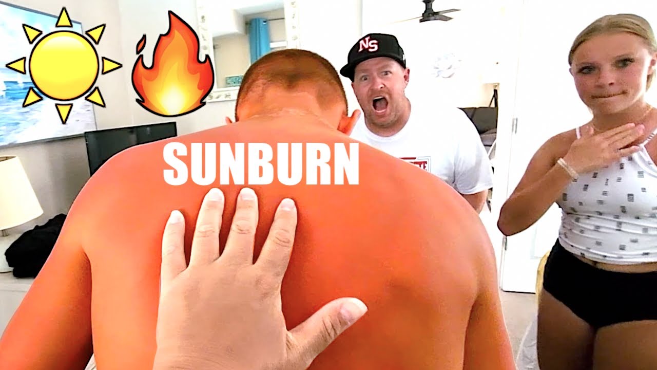 WHO GOT THE WORST SUNBURN? ☀️🔥