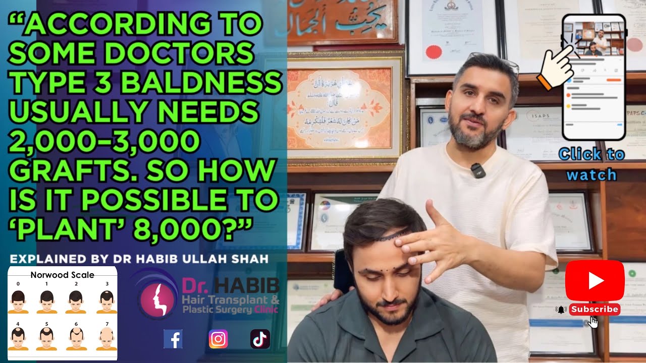Does type 3 baldness need 3,000 grafts? How’s it possible to plant 8,000 grafts🤔| Dr. Habib explain 