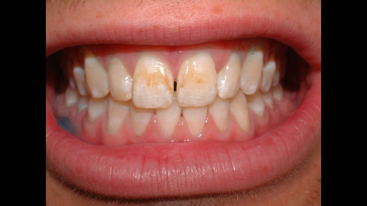 Common Dental Problems: Stains