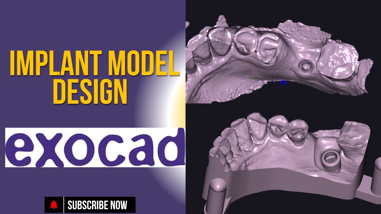 Creating an Implant Model in Exocad: Step-by-Step Guide
