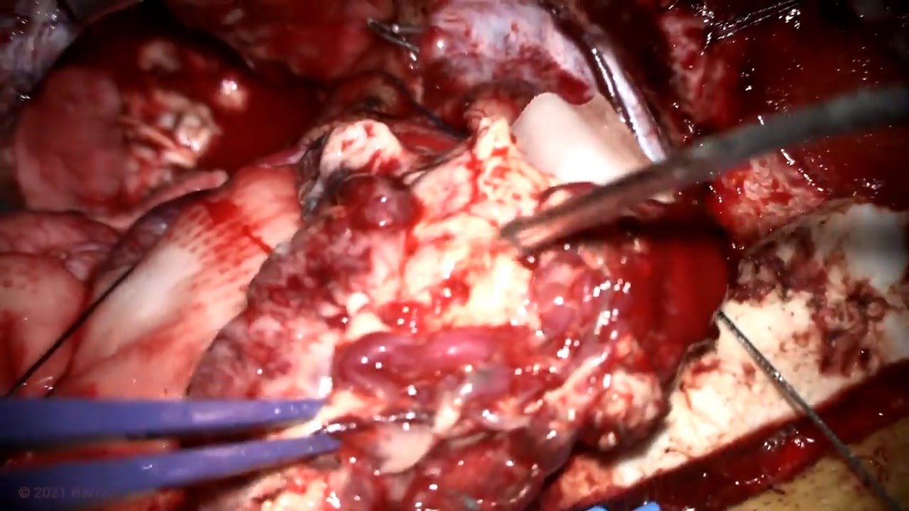 Contralateral Posterior Interhemispheric Approach and Transfalcine Resection of Occipital AVM