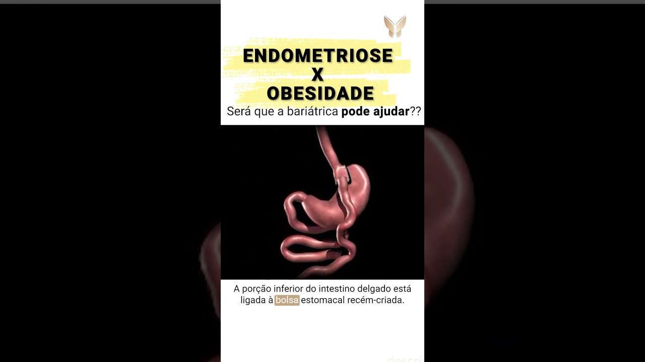 ENDOMETRIOSE x BARI&Aacute;TRICA - Ser&aacute; que a bari&aacute;trica pode ajudar? | EndoMater