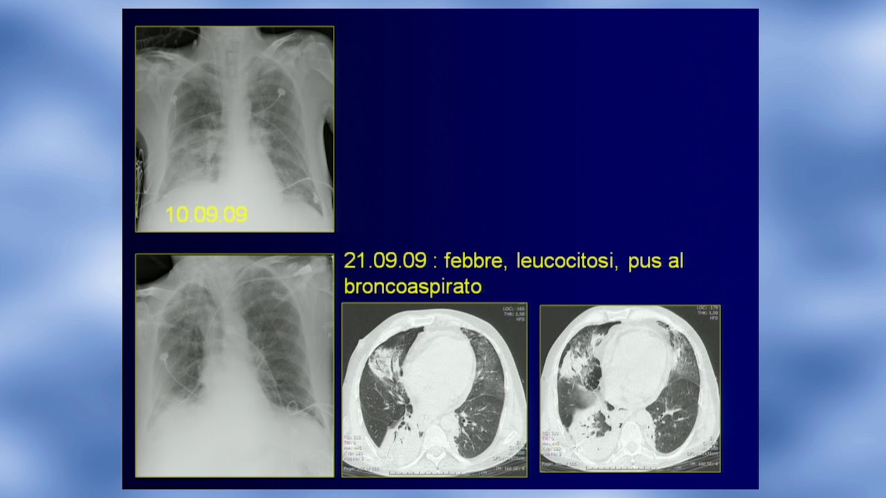 11 Il paziente in Rianimazione: infezione? edema? ARDS? Fabio Falaschi