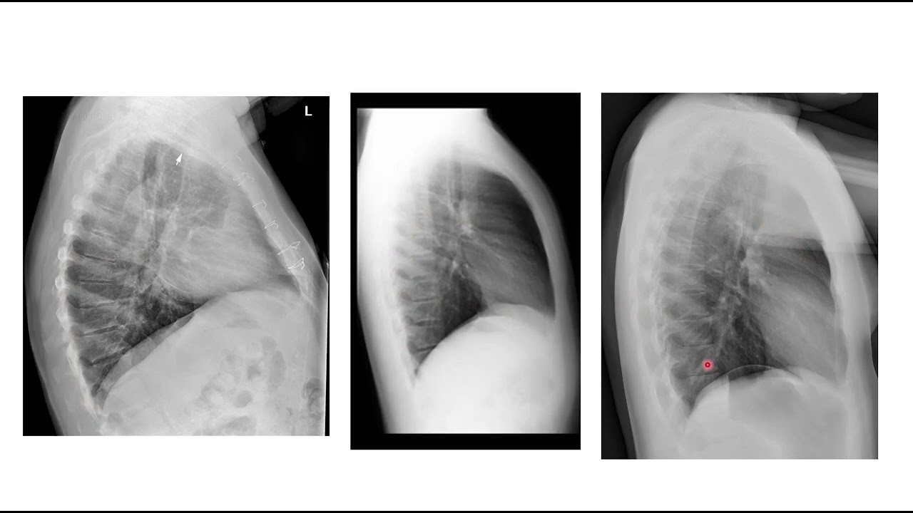 rotation lateral chest x ray