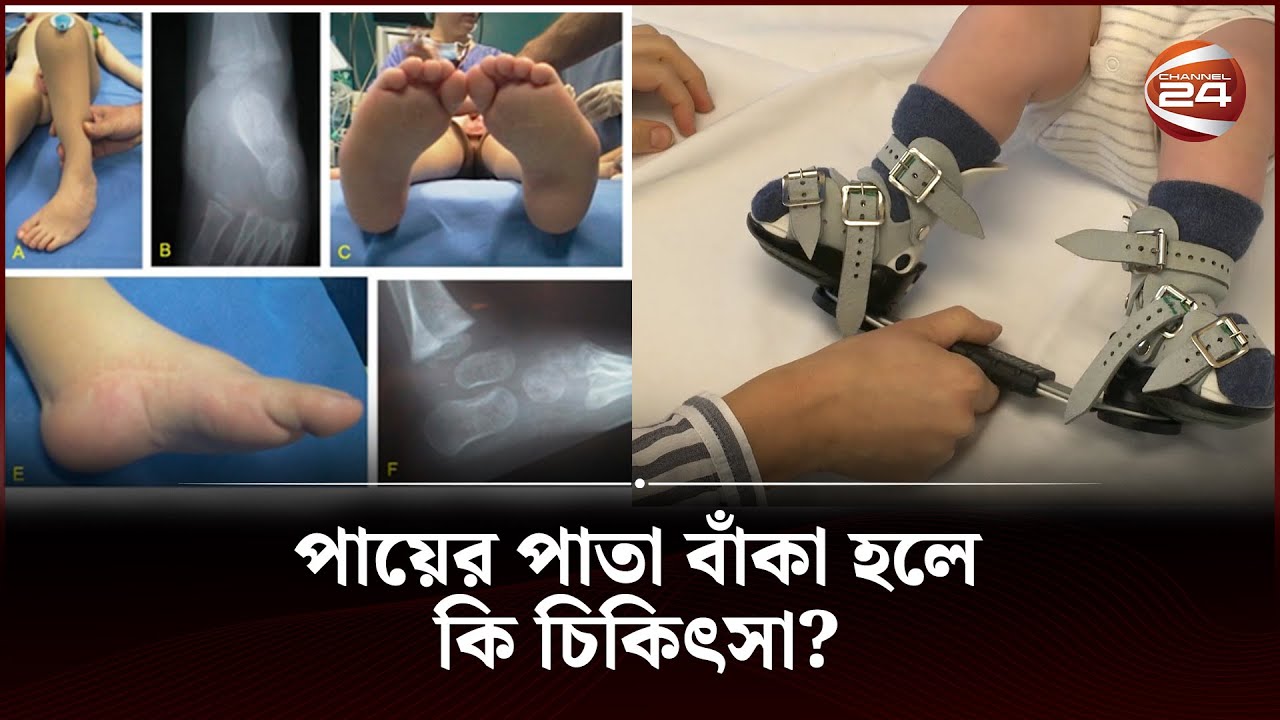 ক্লাব ফুট: পায়ের পাতা বাঁকা হলে কি চিকিৎসা? | Clubfoot treatment | Channel 24