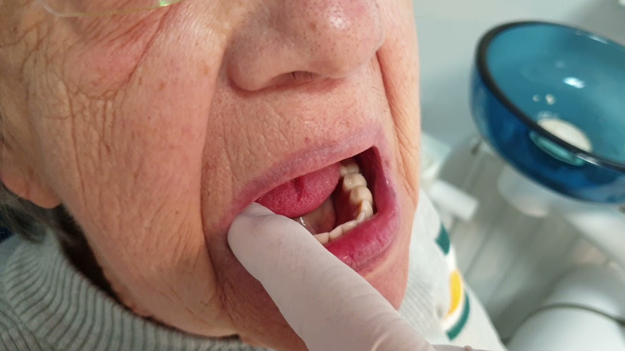 Vertexdental - Biofix Als&oacute; V&aacute;kuumos fogsor