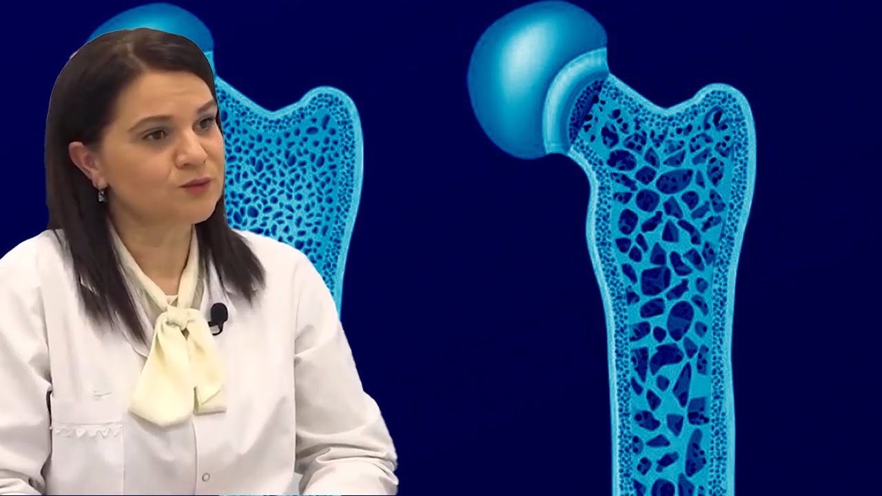 A ka shërim Osteoporoza! Flet mjekja Ergeta Ktona! | Dritarja e Doktorit