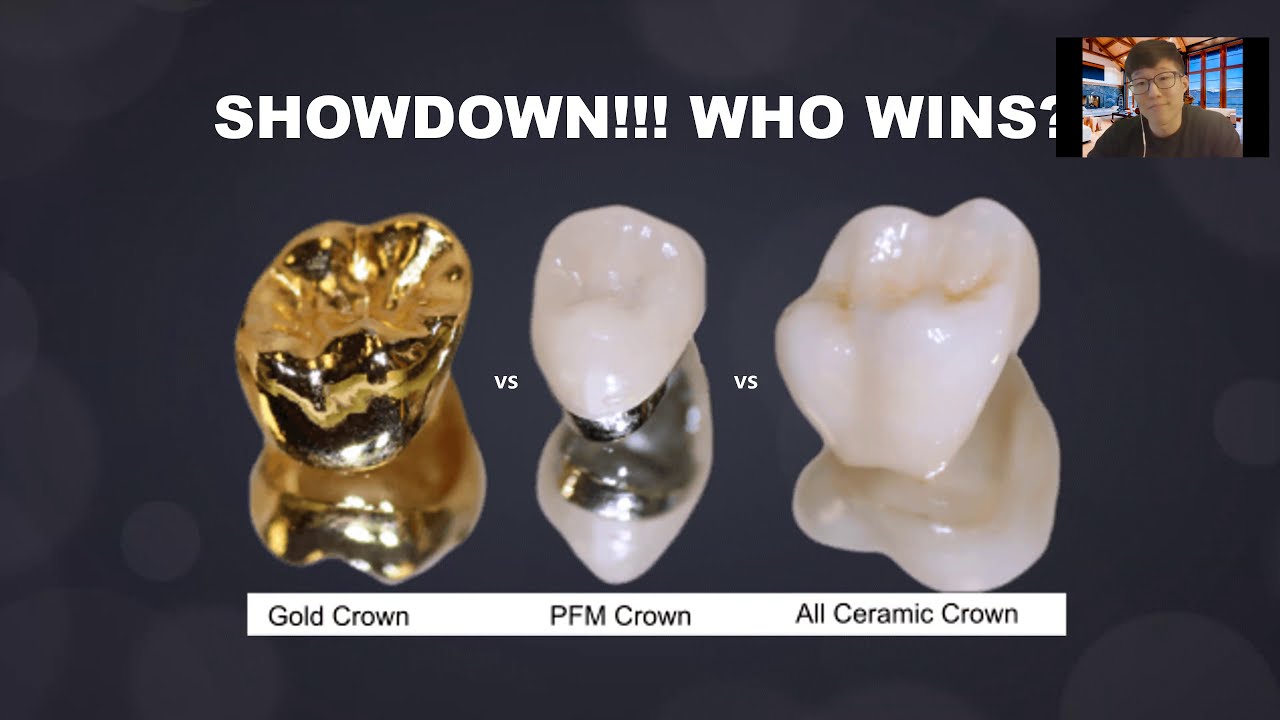 Porcelain Fused Metal (PFM) Dental Crown (For Predental Students)