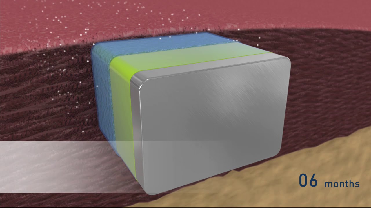 Orsiro Hybrid drug eluthing stent