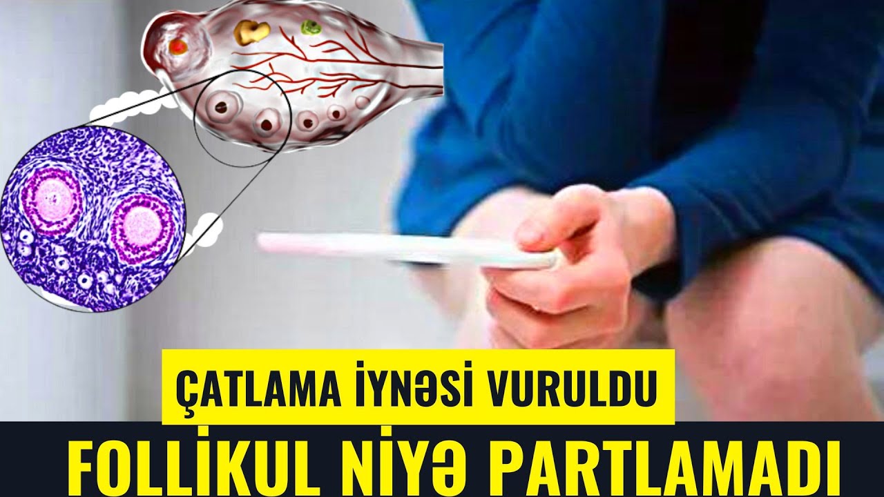 Ovulyasiyanız Bu Səbəbdən Baş Tutmur! - Follikul Niyə Partlamadı?