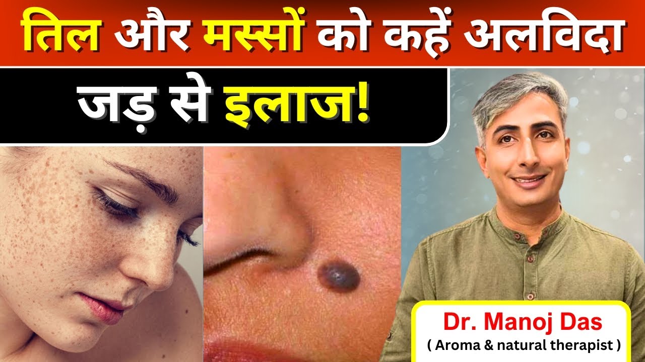 तिल और मस्से बिना लेज़र या सर्जरी जड़ से ख़त्म | तिल और मस्से का इलाज | Moles & Warts I DR. MANOJ DAS