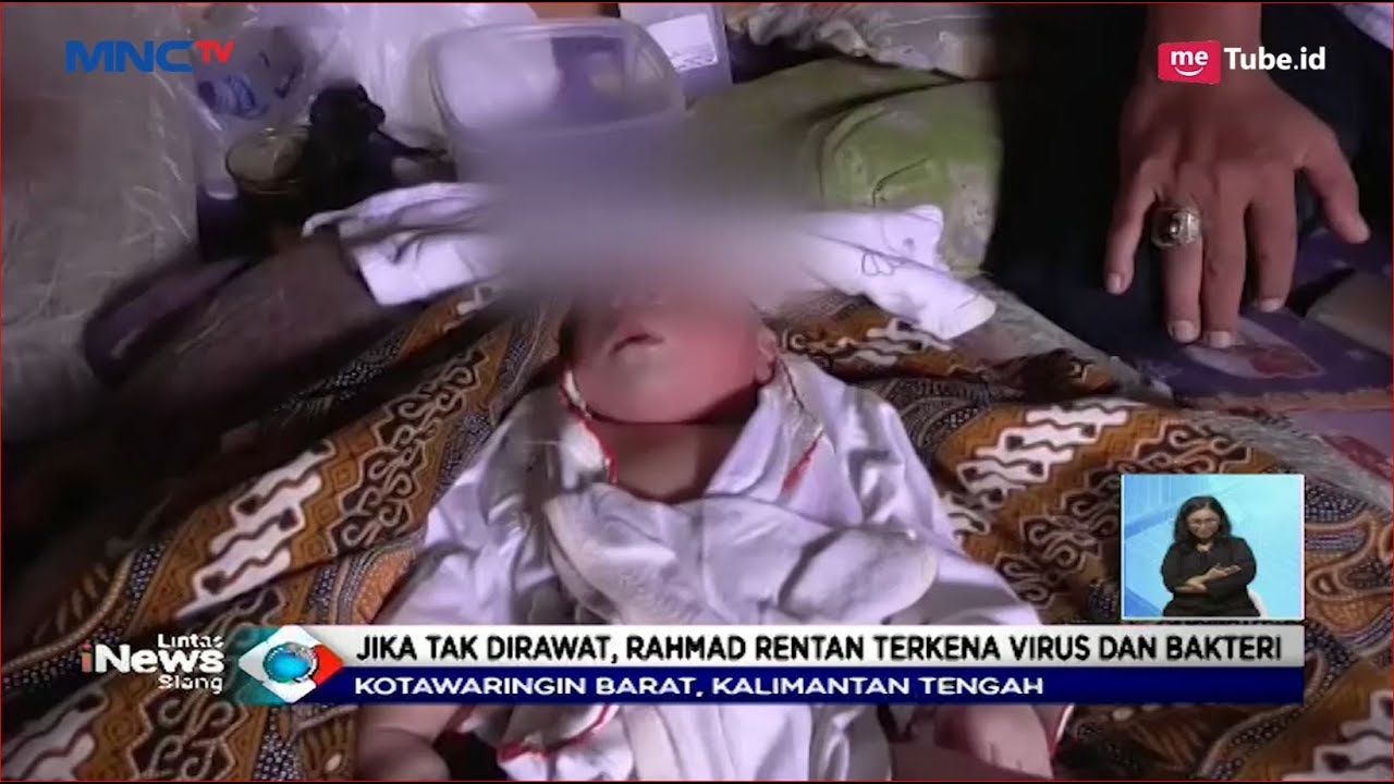 Bayi Ini Lahir Tanpa Batok Kepala, Rentan Terkena Virus dan Bakteri - LIS 09/01