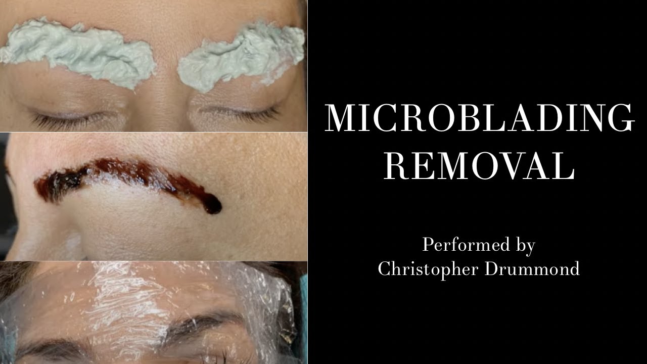 Fixing Botched Microblading: How I Correct Bad Eyebrow Tattoos by celebrity cosmetic tattoo artist