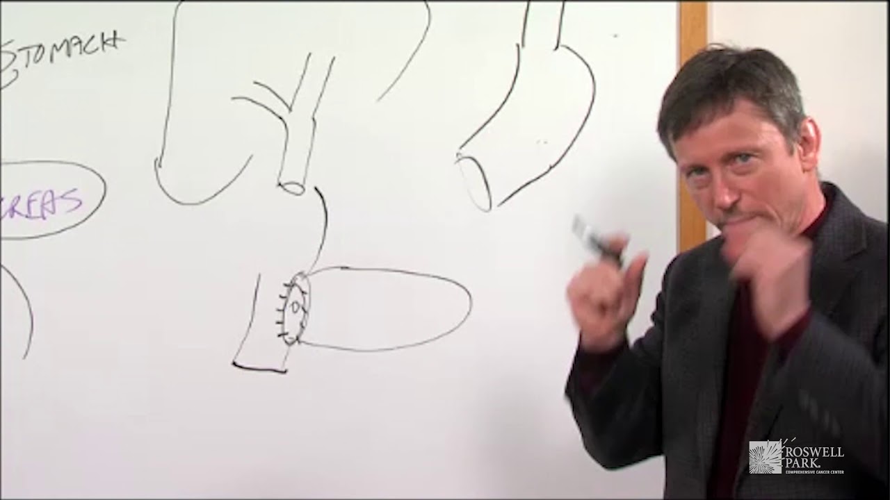 Whipple Operation Description | Roswell Park Patient Education