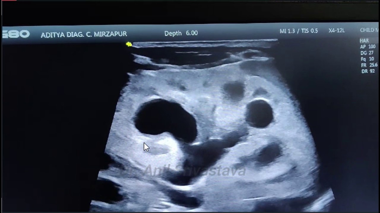 POSTERIOR URETHRAL VALVE IN INFANT