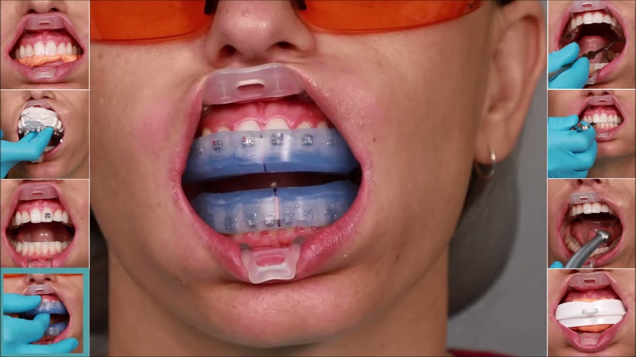 Clear Access for All Procedures   Umbrella™ Tongue, Lip, & Cheek Retractor