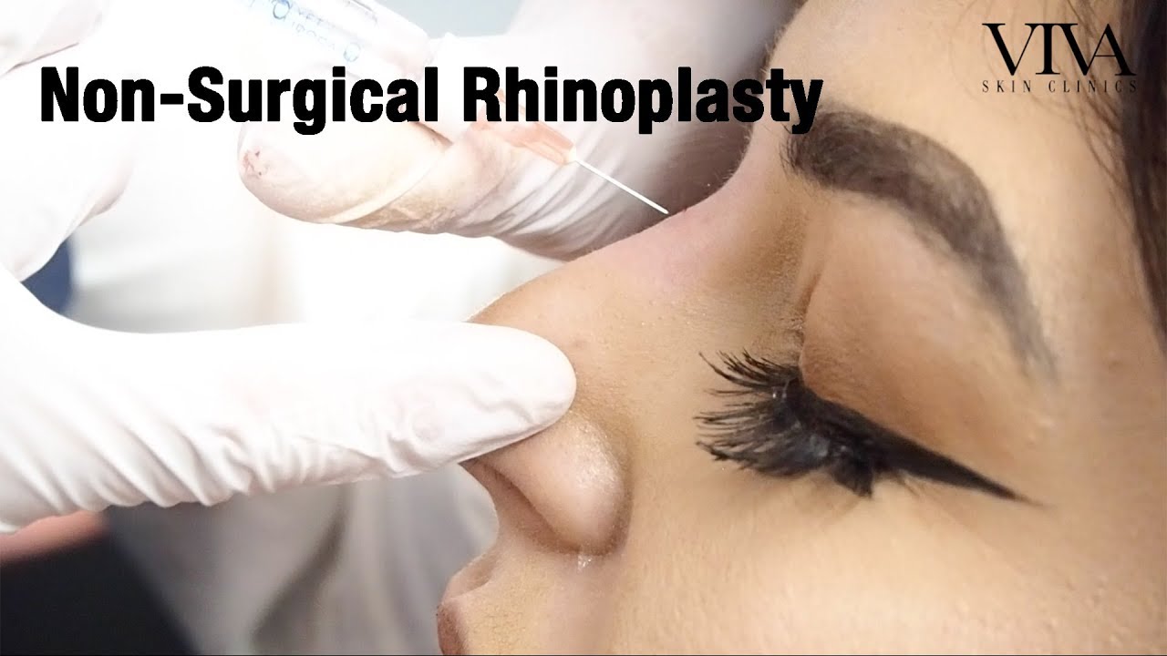 Non-Surgical Rhinoplasty | VIVA Skin Clinics