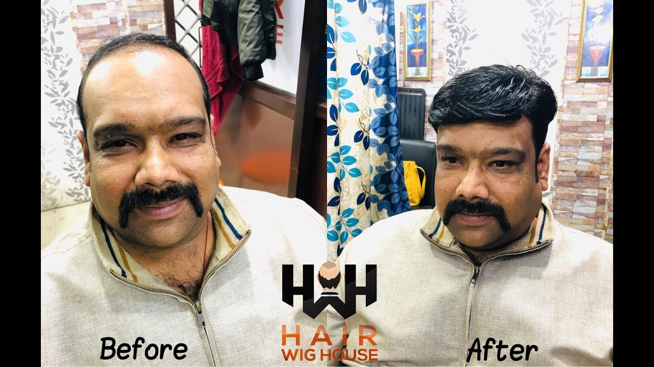 Before & After a Non Surgical Hair Replacement for Men in Delhi | Hair Weaving | 9953384242