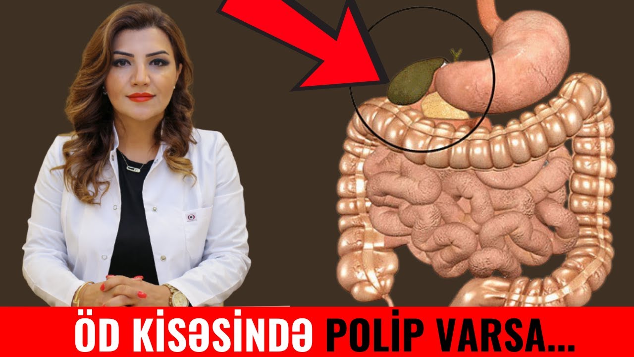 Öd kisəsində polip aşkarladıqda nə etmək lazımdı?