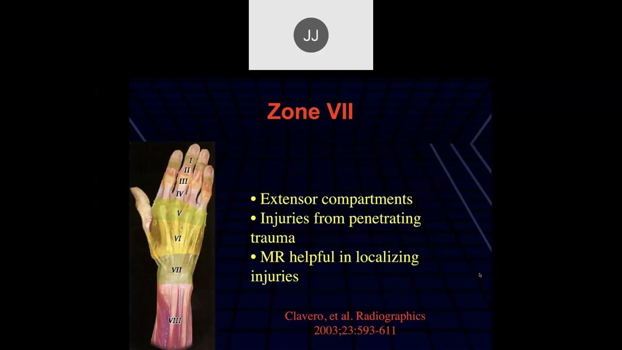 MRI of the Wrist, Part 8 | Wrist Tendons