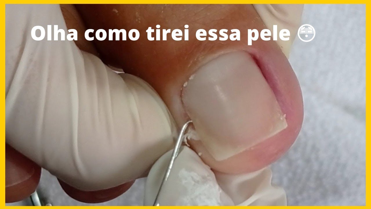 Como fazer a unha do pé sem machucar!Veja o que eu fiz para tirar as peles😳