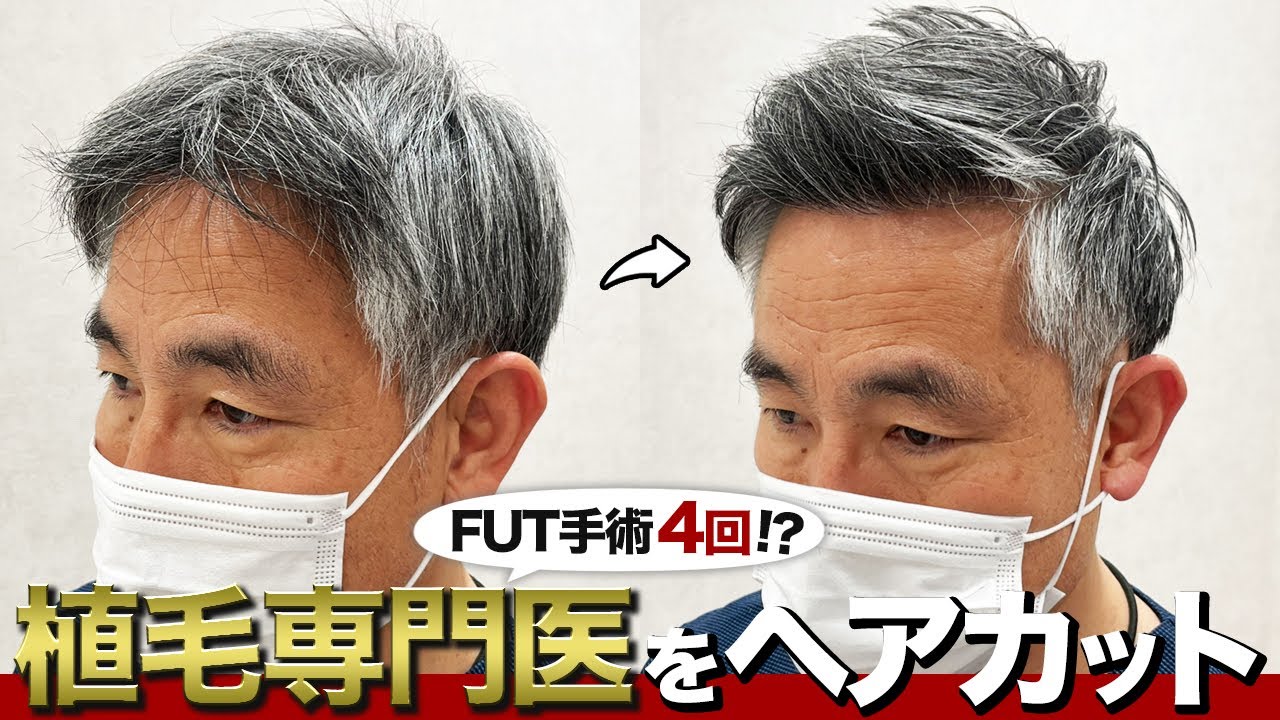 【植毛専門医】FUT手術の傷を隠すヘアカット！植毛について詳しく解説！