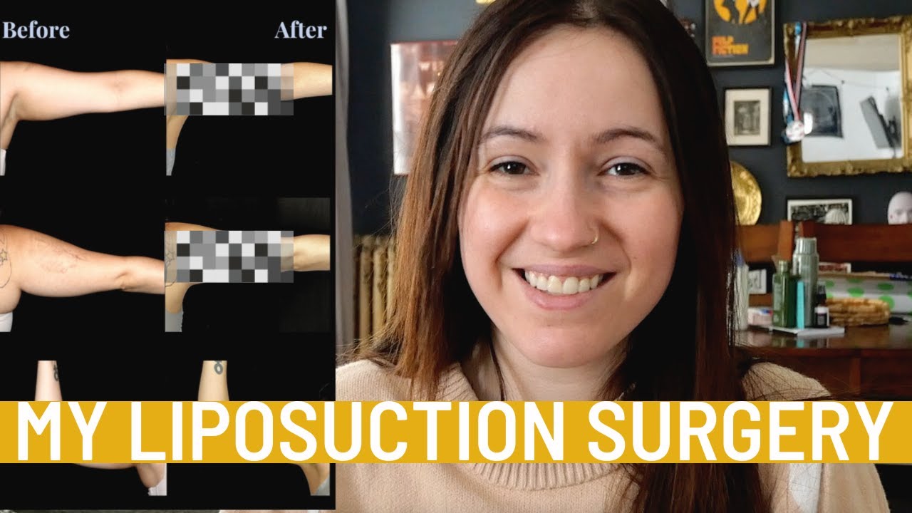 i got liposuction surgery (EXPERIENCE, COST, RECOVERY)