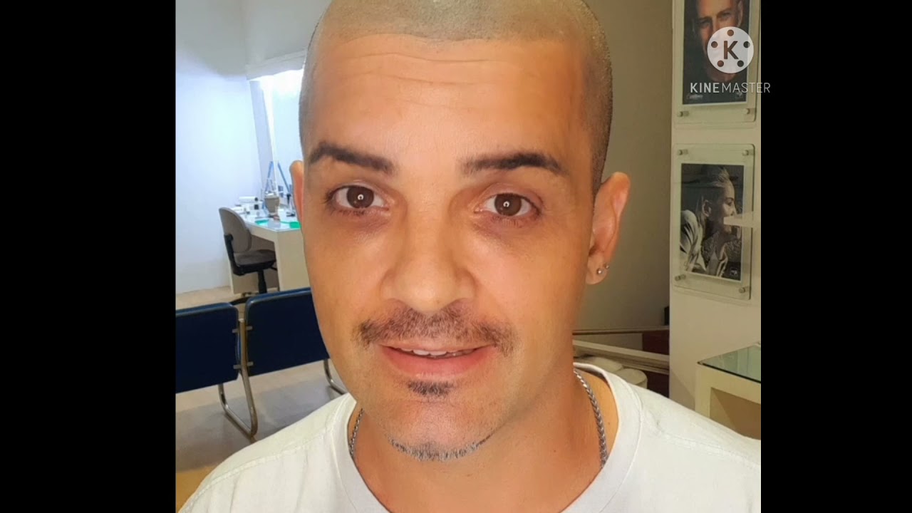 Acabando com o brilho da careca | micropigmentação capilar Excellence