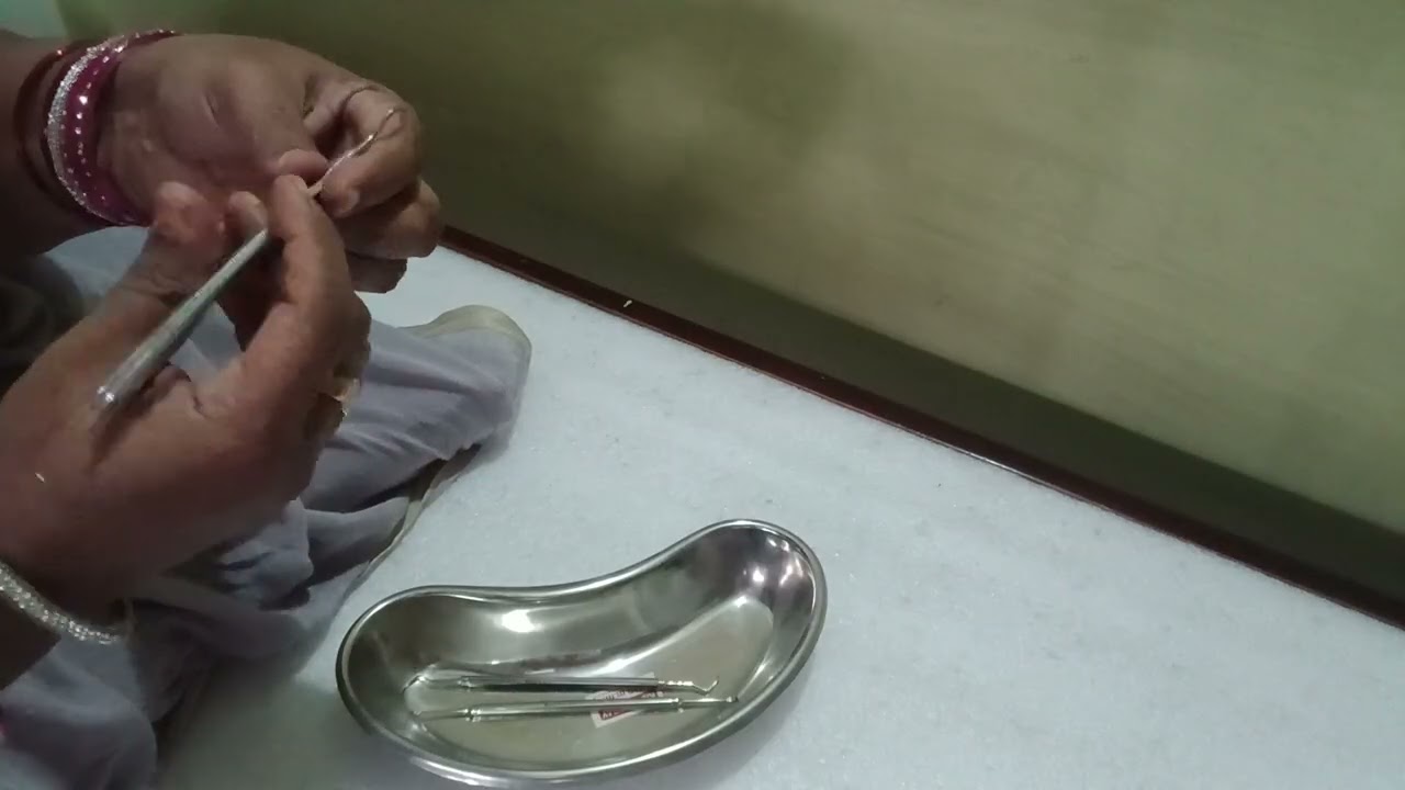 scaling చేసే విధానం (scaling by removing plaque with handscalers)