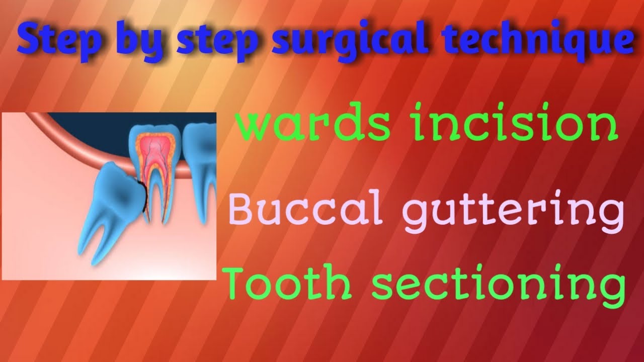 Impacted wisdom teeth part-2
