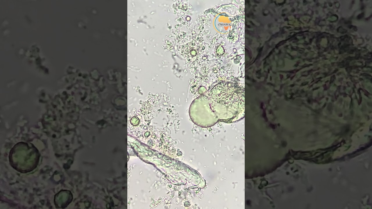 🧈 Comment reconna&icirc;tre les particules graisseuses en coprologie ? 💩