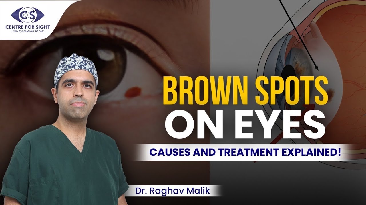 Brown Spots in the Eye – Should You Worry? | Dr Raghav Malik | Centre For Sight Delhi
