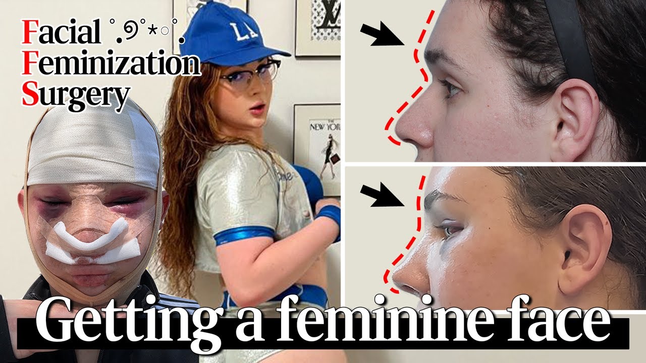Essential Guide to FFS : Facial Feminization Surgery for Trans 🌈🏳️&zwj;⚧️